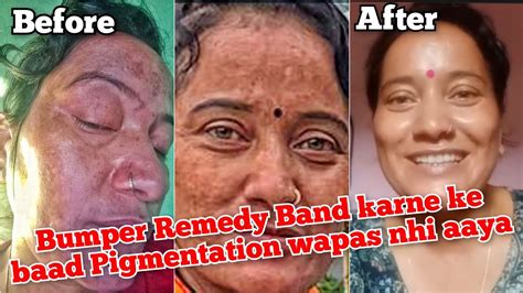 Bumper Remedy Band Karne Ke Baad Pigmentation Wapas Nhi Aaya Cooking