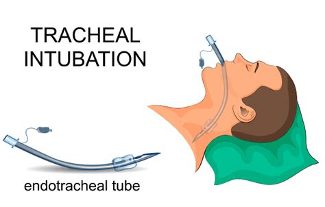 Uses And Types Of Endotracheal Tubes Step To Health