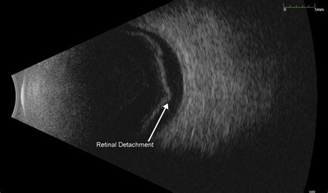 Eye Disease Diagnostic Tests Hawaii Retina Consultants