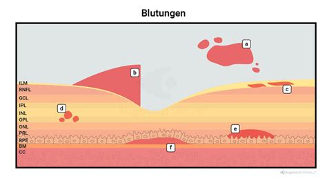 Netzhautblutungen Lexikon Der Augenheilkunde