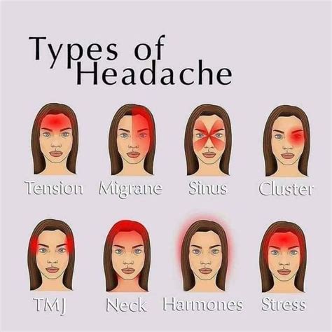 Types of headache – Artofit