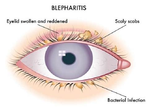 La Blefaritis Causas Síntomas Diagnóstico Y Tratamiento