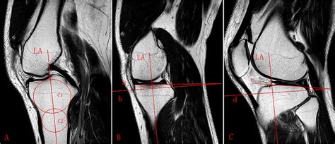 Lateral and medial PTS. A sagittal MRI image shows the tibial... | Download Scientific Diagram