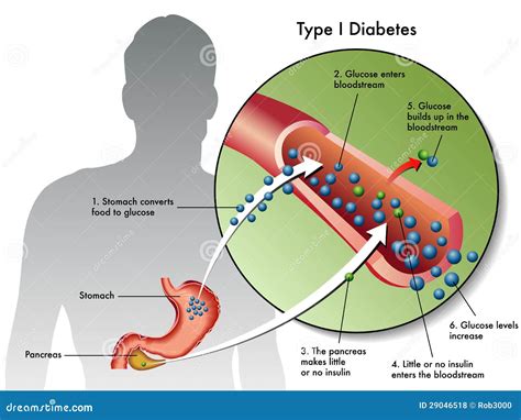 Type 1 Diabetes Royalty Free Stock Photos - Image: 29046518