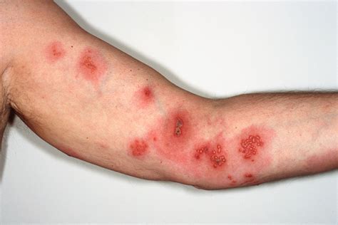 Pictures Of Shingles Rash Part 2 Shingles Expert