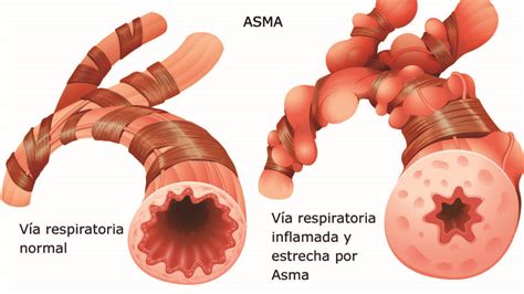 Al Rgias Y Su Manejo El Asma