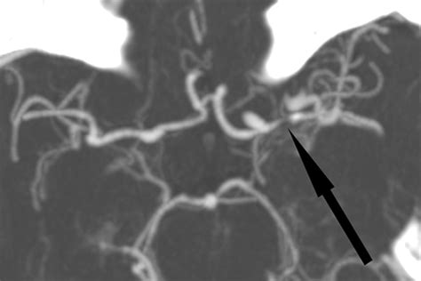 Imaging Of Stroke Part Perfusion Ct Overview Of Imaging Technique