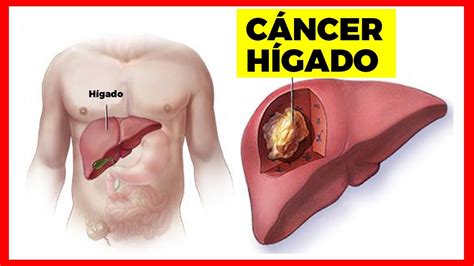 11 SIGNOS DE CÁNCER DE HÍGADO QUE NO DEBES IGNORAR Y COMO PREVENIRLO