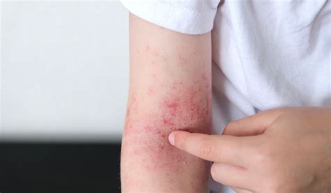 Understanding Psoriasis Causes Symptoms And Treatments Nigro Dermatology Group