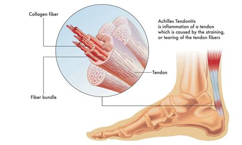 Understanding Achilles Tendinitis Causes Symptoms Diagnosis