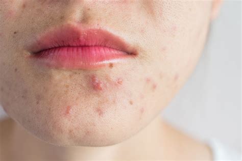 Accutane Treatment Understanding The Science Behind It