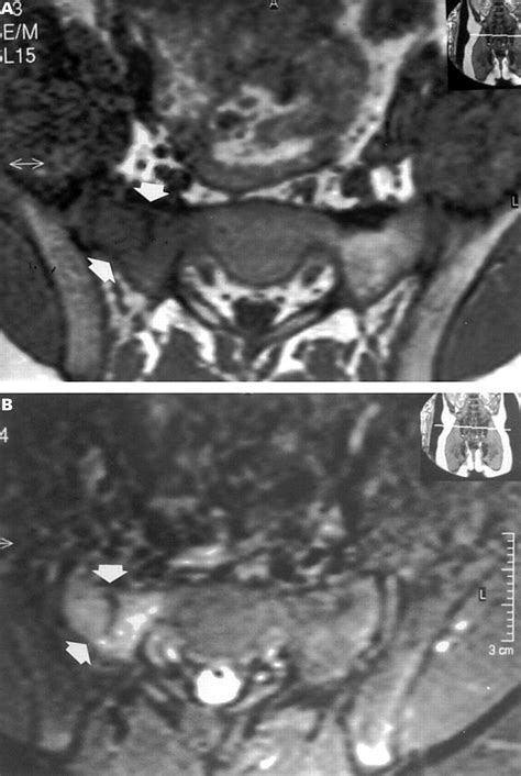 Stress Fracture Sacrum Running at Fred Grant blog
