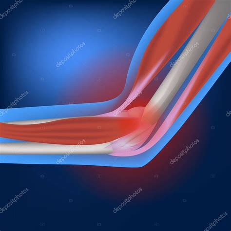 Epicondilitis De La Articulaci N Del Codo Lesi N Inflamatoria Y