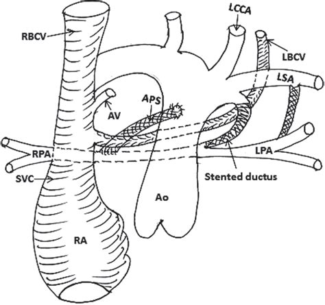 Diagrammatic Representation Of Use Of Retroaortic Left Brachiocephalic Download Scientific