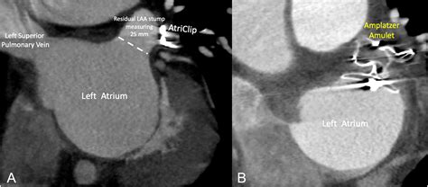 Long Term Imaging And Clinical Outcomes Of Surgical Left Atrial