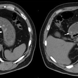 Abdominal Computed Tomography Demonstrating Multiple Sticklike And