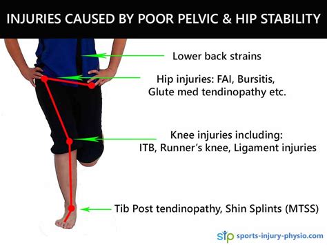 Injury Prevention 101 Glute Med Exercises Sports Injury Physio