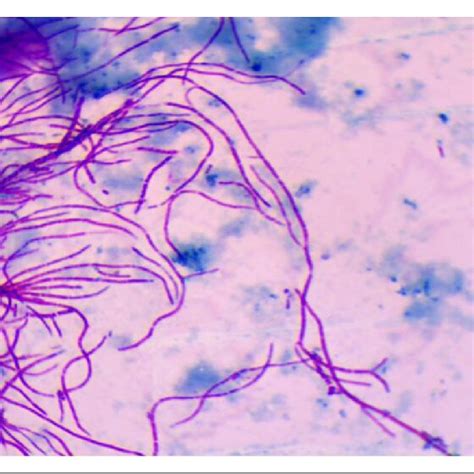 Modified ZN Ziehl Neelsen Stain Showing Partial Acid Fast Branching