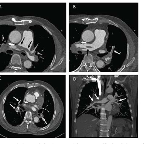 Figure 3 From Diagnostic Yield Of Ct Pulmonary Angiography In The