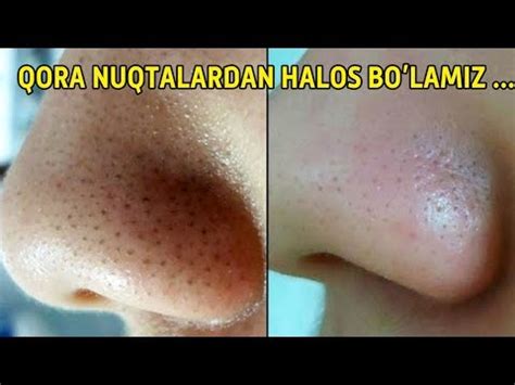 Как в домашних условиях почистить нос от черных точек: Как избавиться ...
