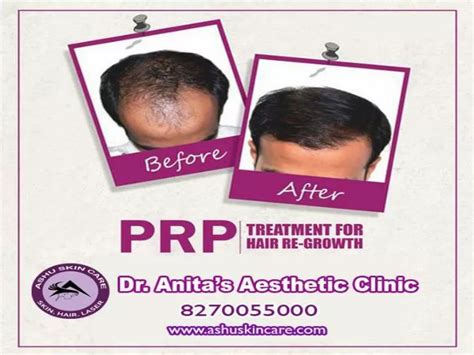 Ppt India S Best Hair Fall And Loss Treatment Clinic In Bhubaneswar Odisha Powerpoint