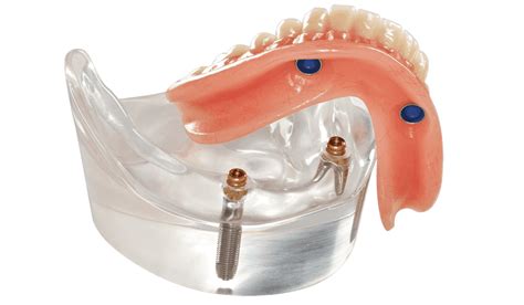 Implant Supported Overdenture: “It’s a SNAP”! — Teletype