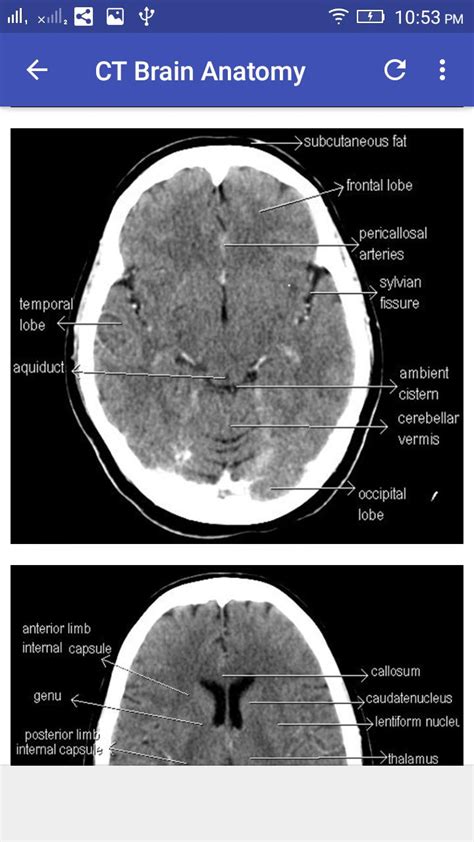 Ct Scan Brain Anatomy - Anatomy Reading Source