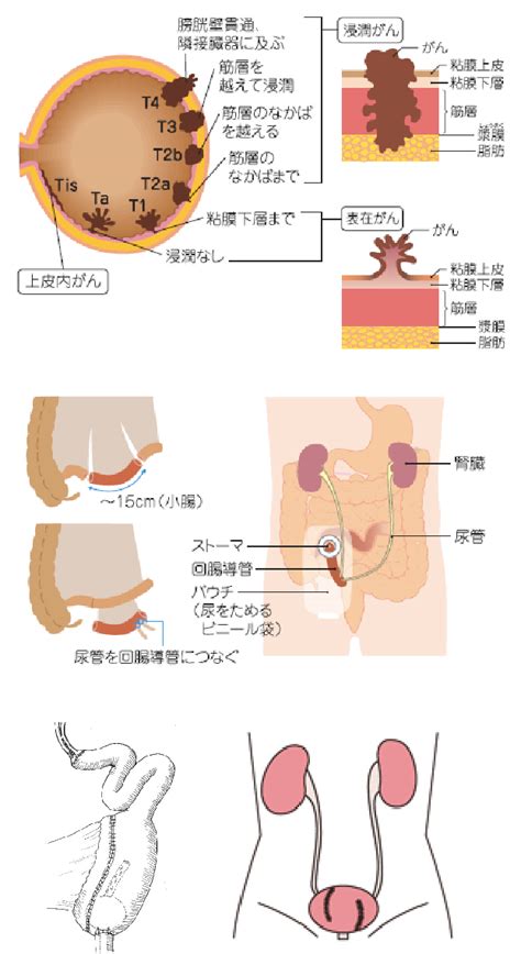 膀胱がん がんセンター