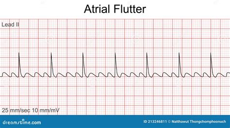 Ventricular Flutter Ecg