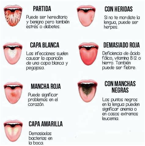 La Lengua Habla Medicoblastos Salud Lengua Lengua Blanca Lengua