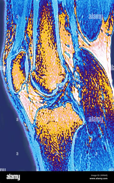 Mrt kniegelenk sagittal Fotos und Bildmaterial in hoher Auflösung Alamy