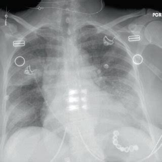 Portable Posterior Anterior Chest X Ray On Admission Showing Multifocal