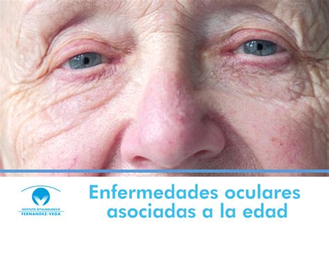 Las Enfermedades Oculares Asociadas A La Edad Blog Fv