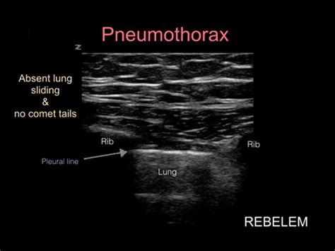 Diagnosing Pneumothorax With Bedside Ultrasound Nuem Blog