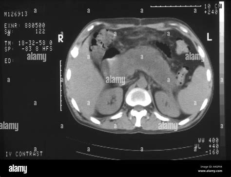 Pancreatitis On Ct Scan