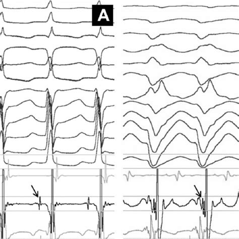 A Intracardiac Electrograms And Selected Surface Electrocardiograms