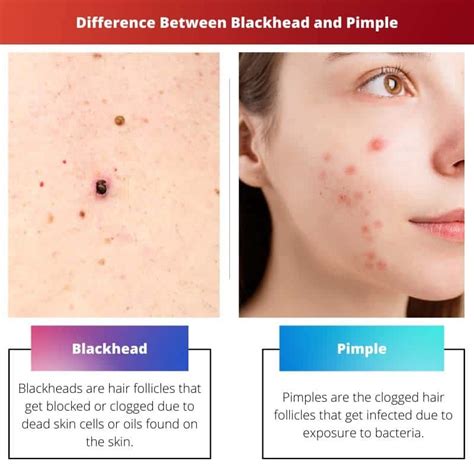 Blackhead Vs Pimple Difference And Comparison