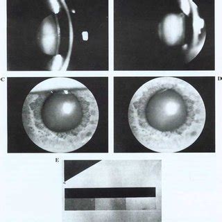 A-E). Images of a human lens with a senile cataract (cortico-nuclear... | Download Scientific ...