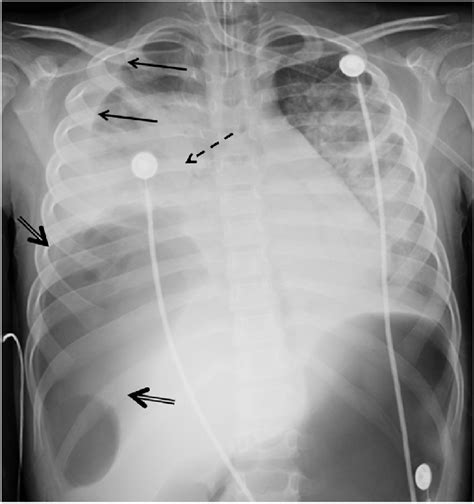 Frontal Supine Portable Radiograph Of The Chest Shows Large Right