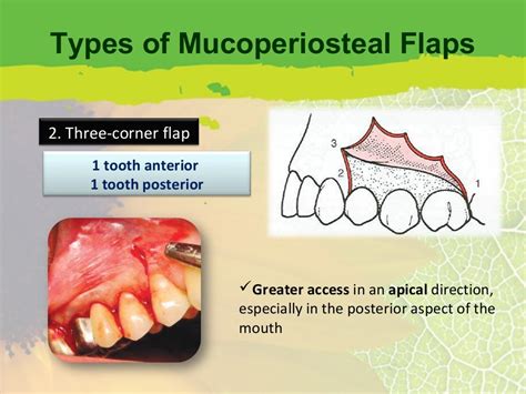 Periodontal Flap Surgery