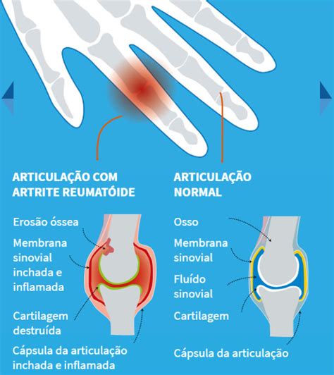 Artrite Reumatoide Como Identificar Prevenir E TratarArtrite