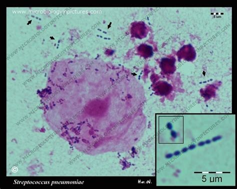 Streptococcus Pneumoniae In Sputum Pneumococcs Morphology And