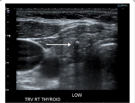 59 Year Old Female Patient With History Of Hashimotos Thyroiditis And