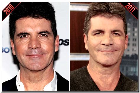 Simon Cowell Admit to Use Botox Injection but Rejects to Undergo Plastic Surgery