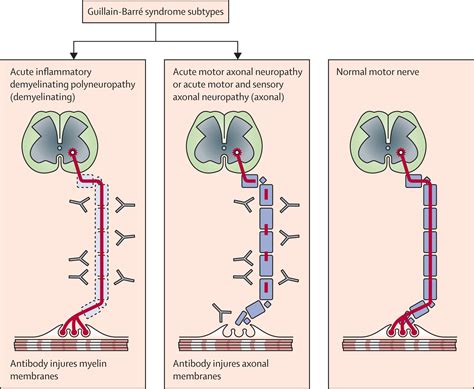 There Can Be Various Underlying Pathologies In Guillain Barre Syndrome