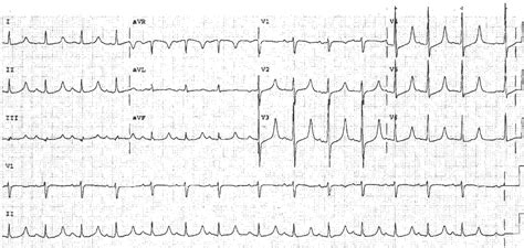 Hyperkalemia And Hypocalcemia On Ecg Manual Of Medicine The Best Porn