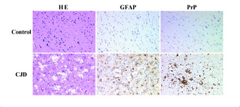 Neuropathological features of transmissible spongiform... | Download Scientific Diagram