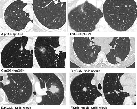 Prognostic Factors For Survival In Multiple Primary Lung Adenocarcinomas A Retrospective