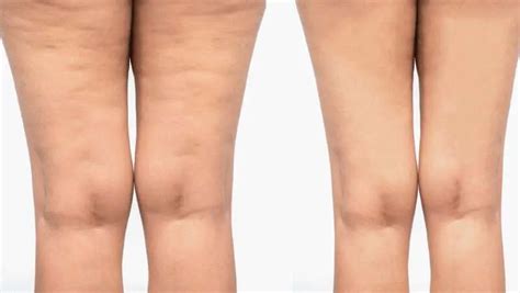 Cellulite Laser Treatment All The Truth Pros Cons Results