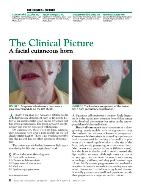 A Facial Cutaneous Horn Cleveland Clinic Journal Of Medicine